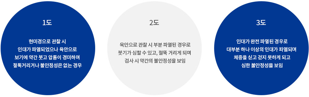 발목인대 손상 단계